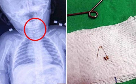 Врачи достали булавку из горла 7-месячного младенца